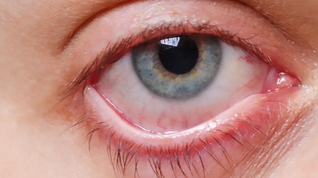 Göz Kuruluğu xerophthalmia