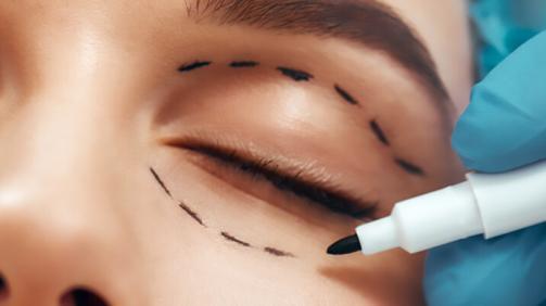 eyelid surgery
