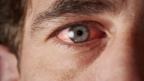 Eye Pressure Treatment