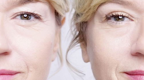 جراحة الجفن المتساقط