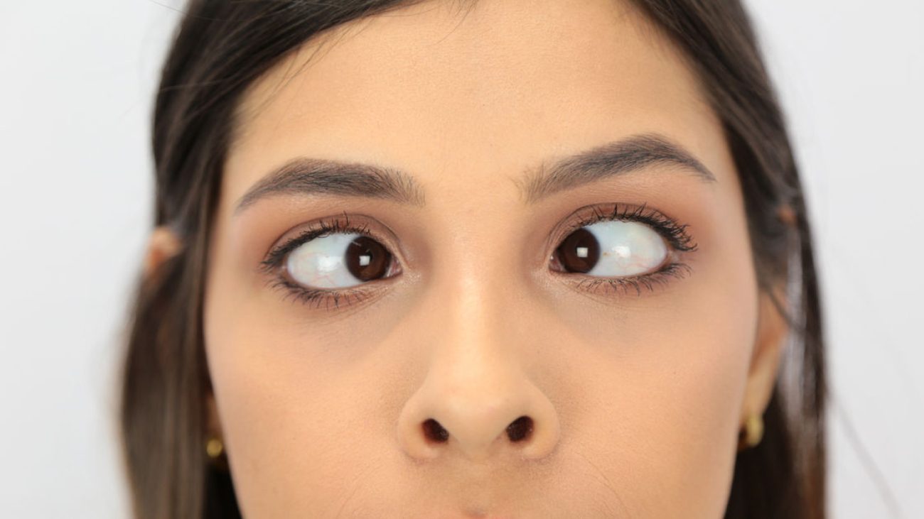 Göz Kayması Ameliyatı