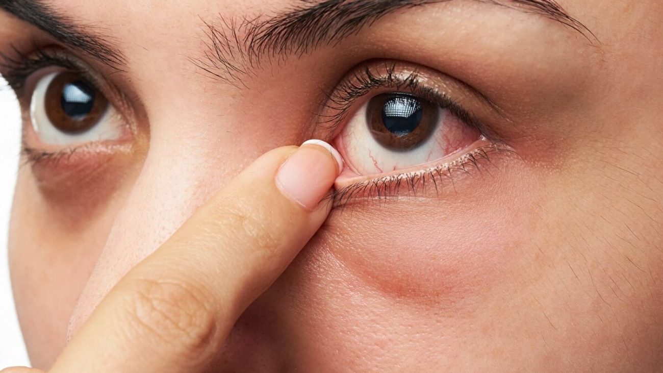 Göz İçi İltihabı