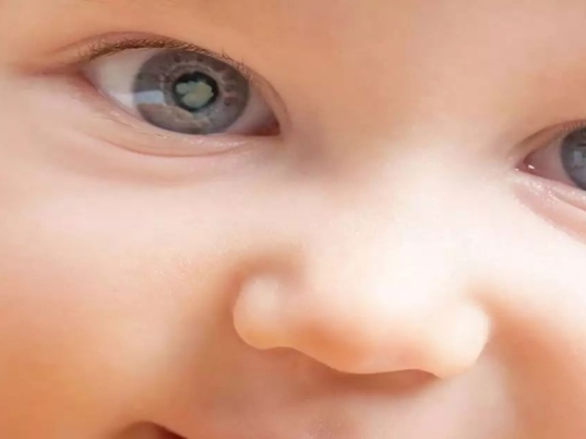 Doğumsal Katarakt Nedir?