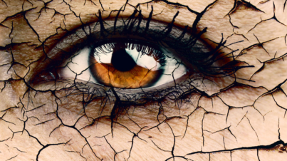 Kuru Göz Hastalığı Nedir?