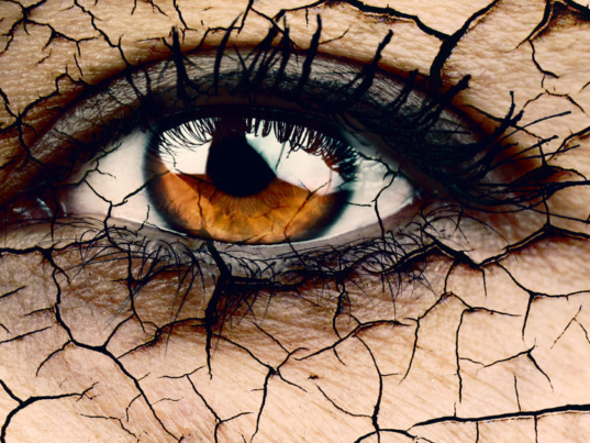 Kuru Göz Hastalığı Nedir?