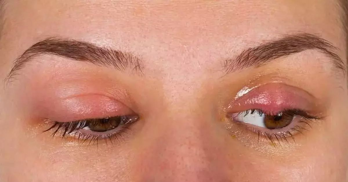 Göz İçi İltihabı Nedir?