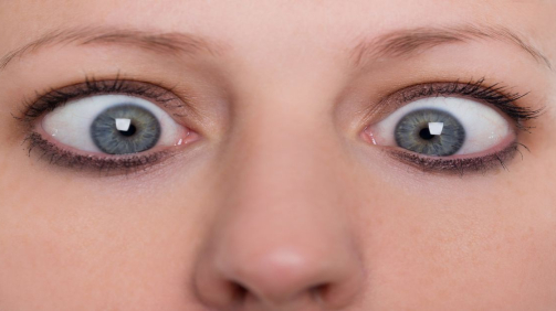 Göz Şaşılığı Nedir?