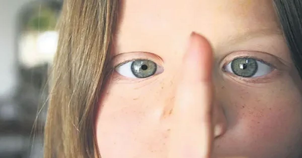 Göz Şaşılığı Tedavisi