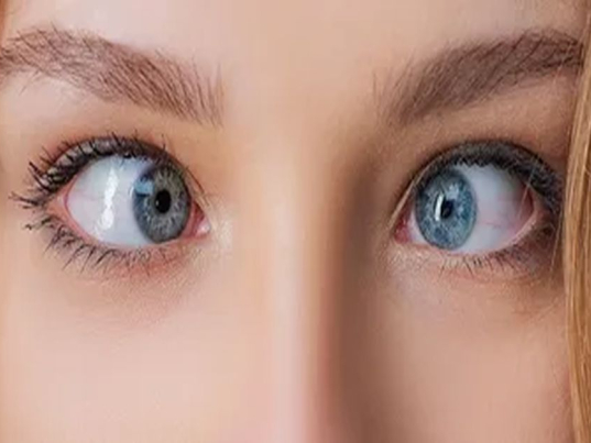 göz-şaşılığı-ameliyatı-3