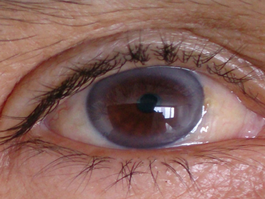 Kornea İltihabı Nedir?