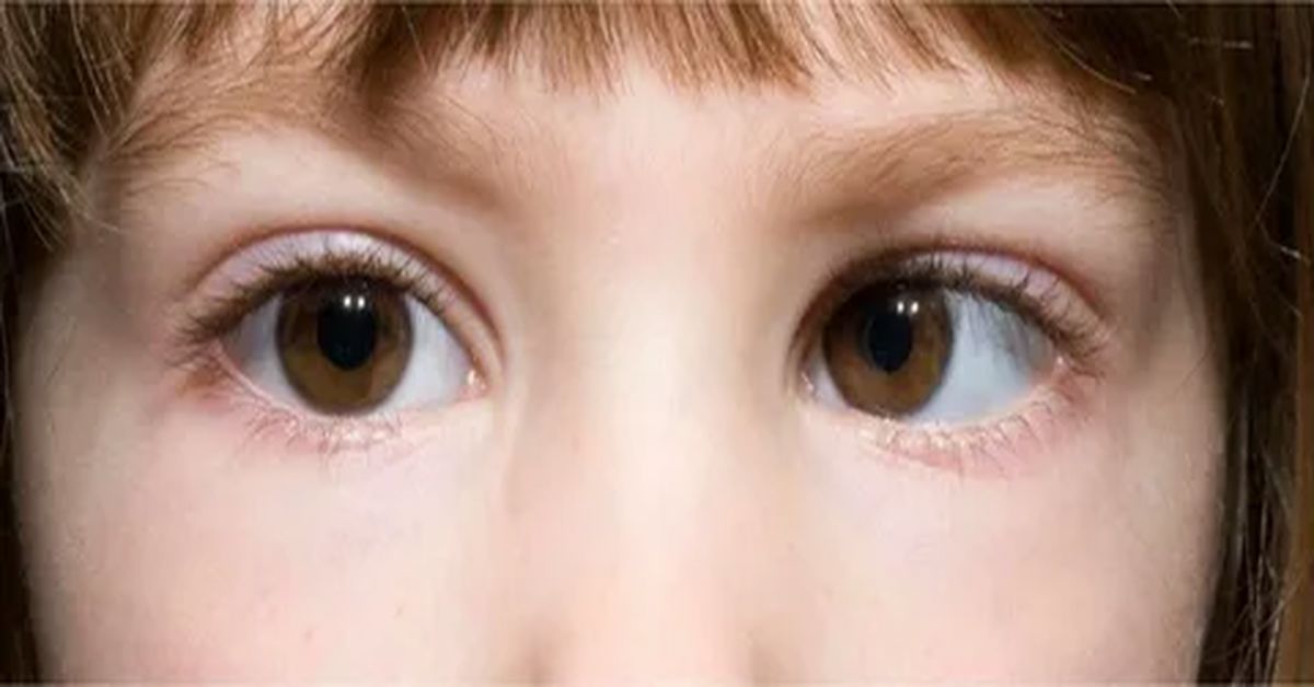 Şaşılık Ameliyatı Nasıl Yapılır